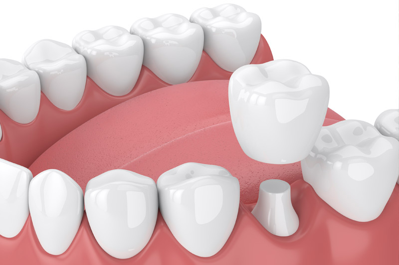 Dental Crowns in Grapevine