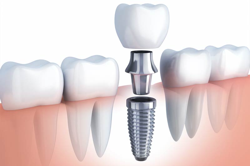 Implants Dentist in Grapevine