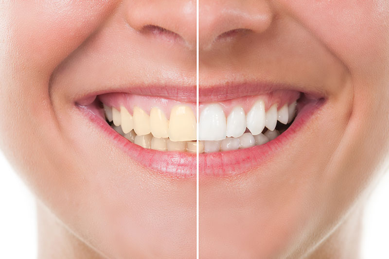 Teeth Whitening in Grapevine