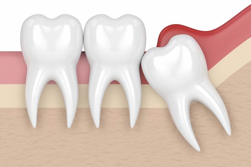 Wisdom Tooth Removal in Grapevine